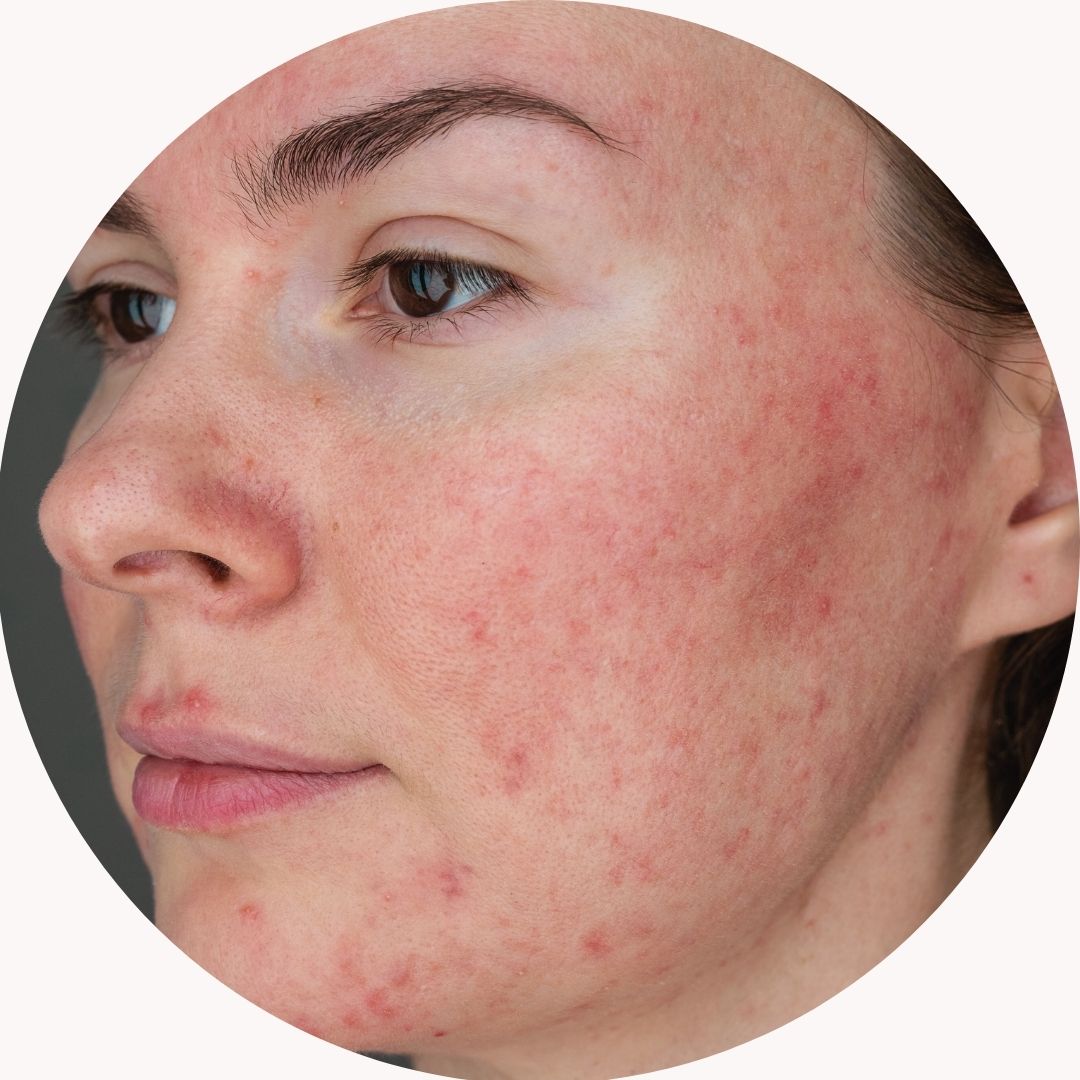 PERSH Rosacea