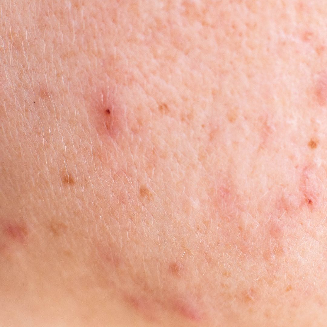 Hautpflege für Akne und Unreinheiten