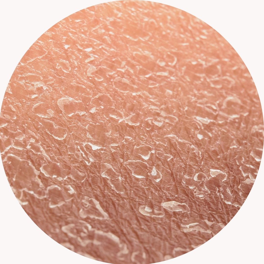 Trockene und dehydrierte Haut